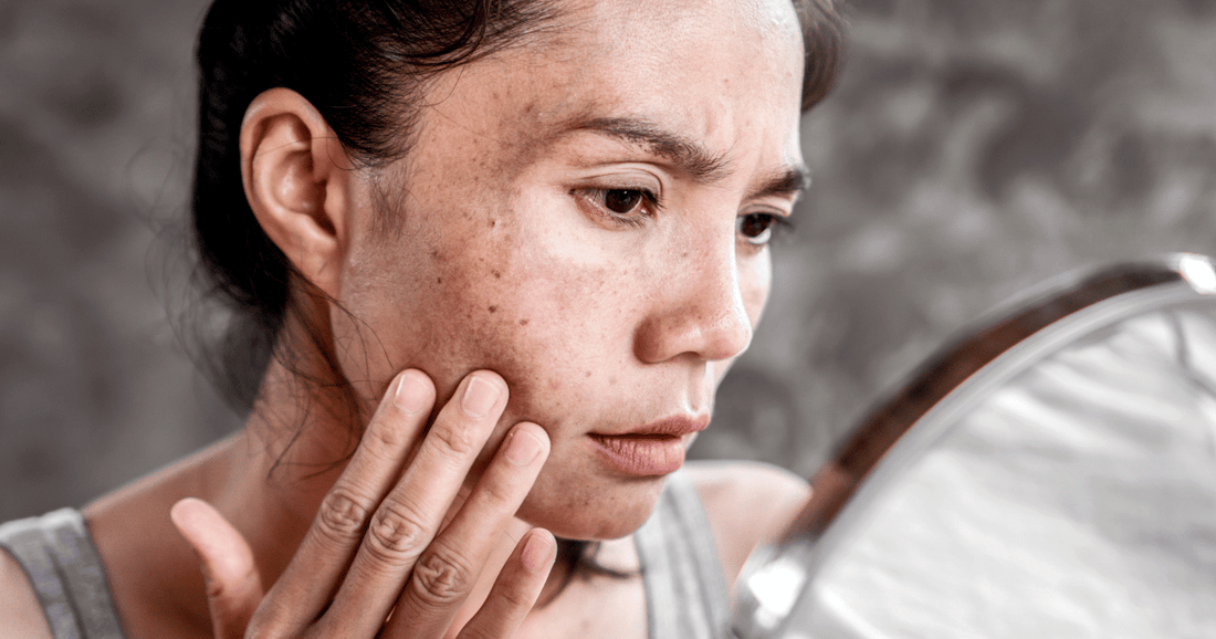 A woman inspecting her face with hyperpigmentation