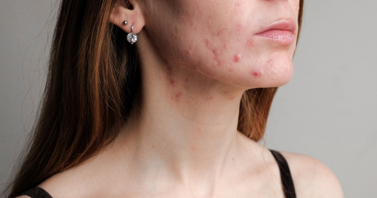 Jenny Nordic Skincare | Woman's jawline with pimles